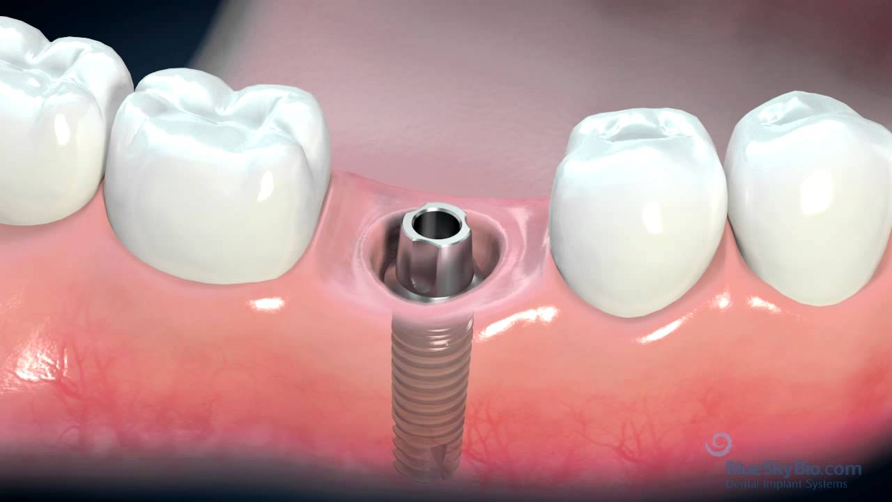 İmplant diş tedavisi süreci