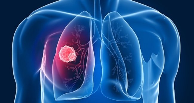 Akciğer Kanseri Nasıl Teşhis Edilir?